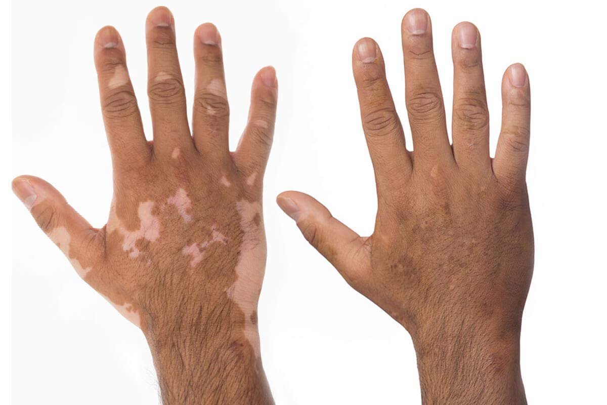 Zanderm Vitiligo Concealer & Camouflage (Warm Dark)